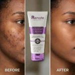 Renate Scarvanish Scar Removal Cream